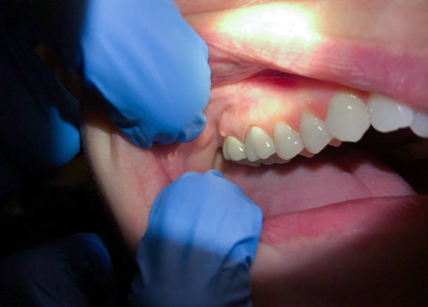 Teeth Whitening in MD